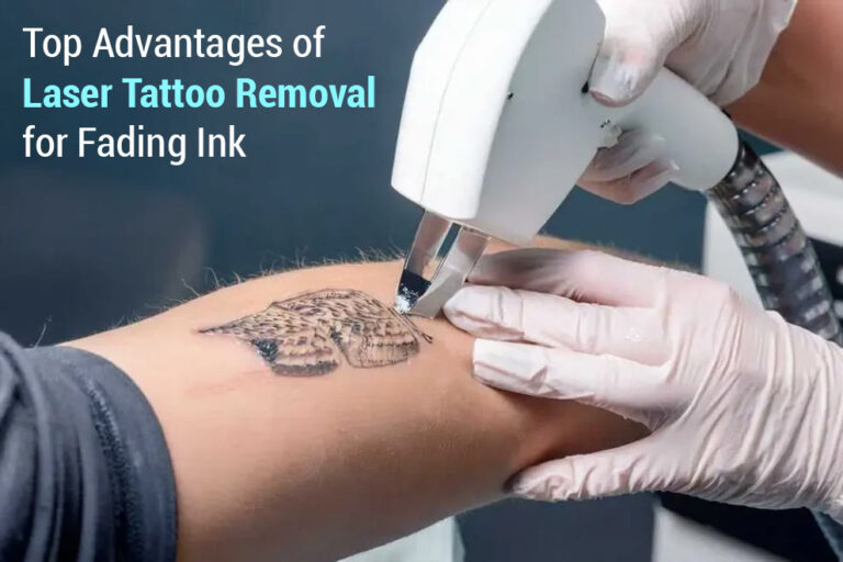 Laser Tattoo Removal